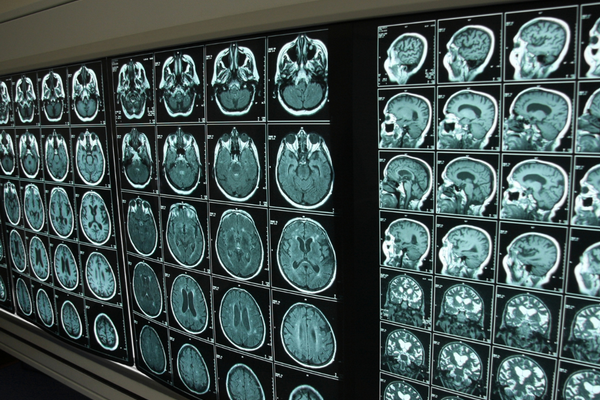 brain scans